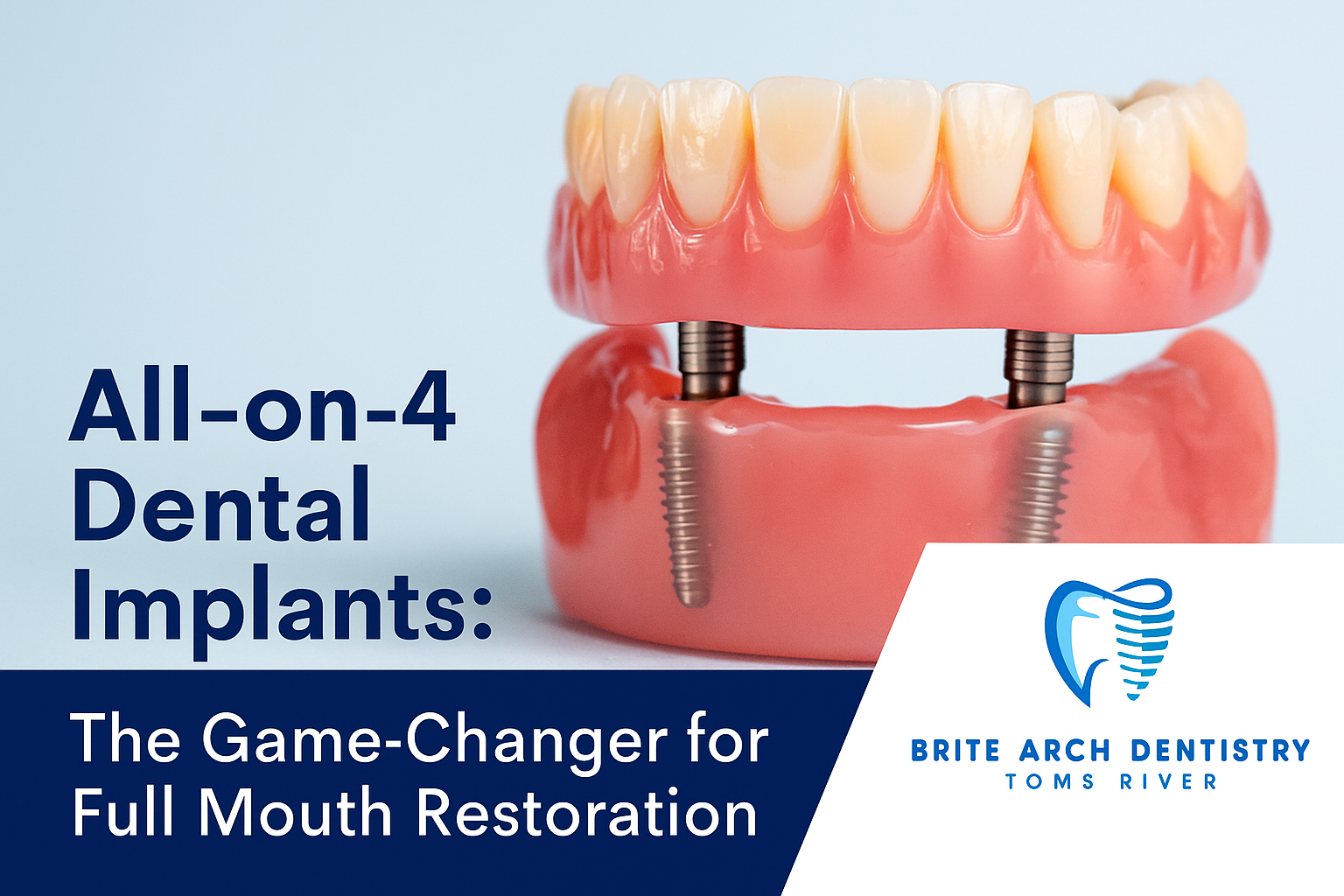 All on 4 dental implants - blog cover